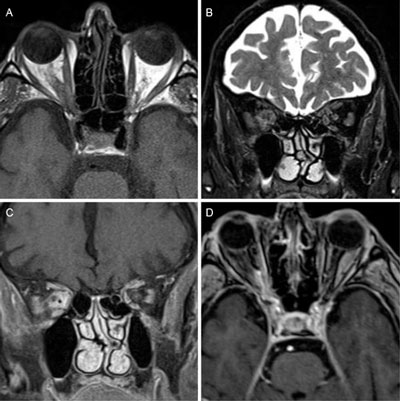 superior orbital fissure radiology