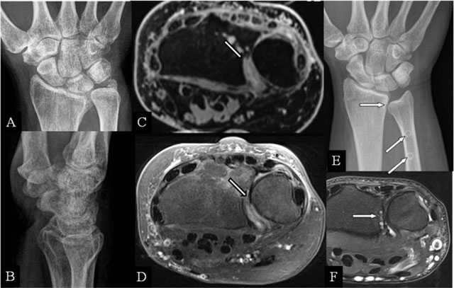 Colles fracture (Pouteau fracture), Radiology Case