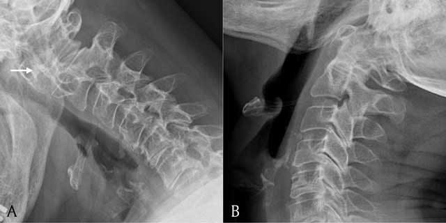 atlanto occipital joint xray