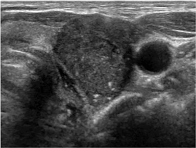 thyroid cyst ultrasound