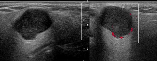 parotid gland tumor ultrasound