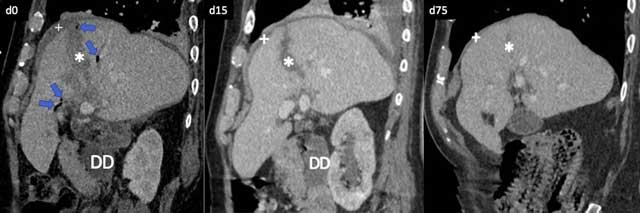 Pneumobilia Caused by Blunt Abdominal Trauma | Journal of the Belgian ...