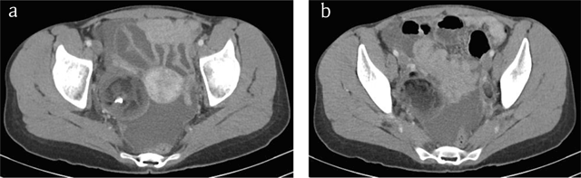 MedPix Case - Ruptured ovarian cyst