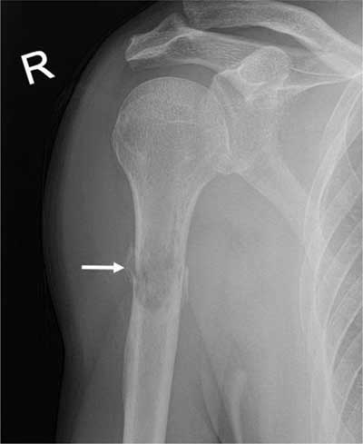 Bone Metastases Images and Xrays