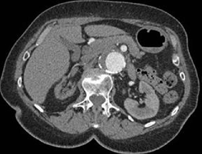 Intravenous Contrast Medium Administration and Scan Timing at CT