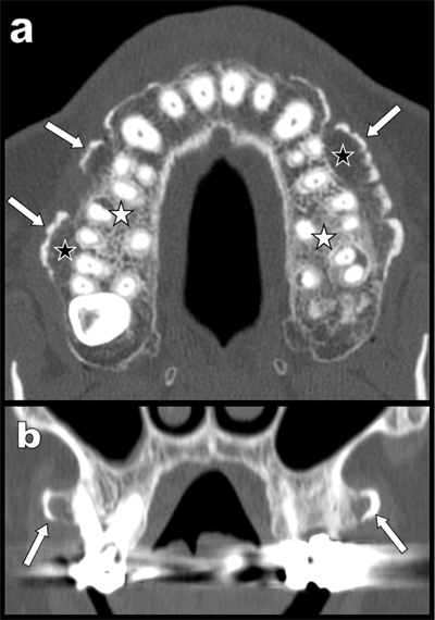 exostosis