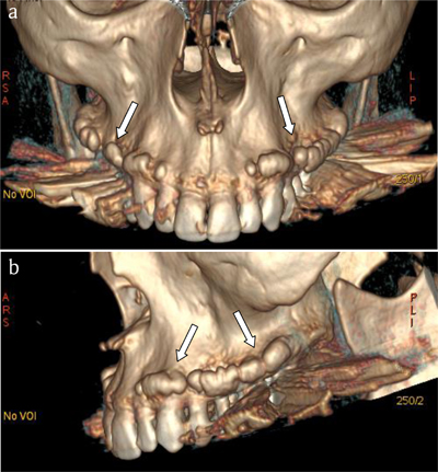 exostosis