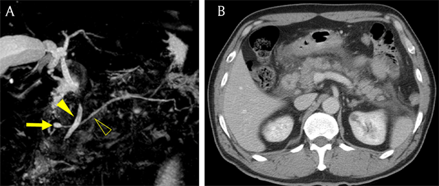 pancreatic divisum mrcp