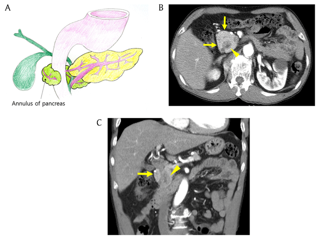 annular pancreas radiopaedia