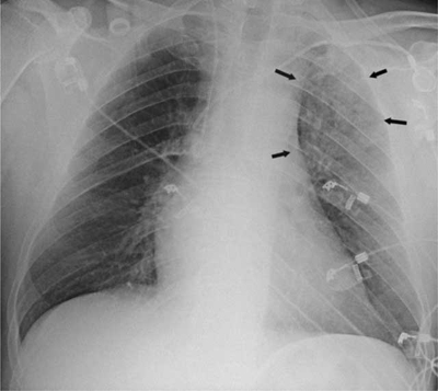 saddle pulmonary embolism xray