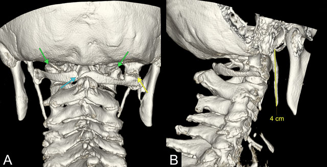 atlanto occipital joint xray