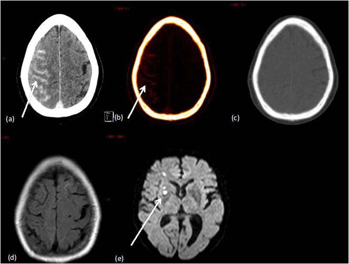 Figure2  Intraventricular Contrast Medium Leakage during Ethanol