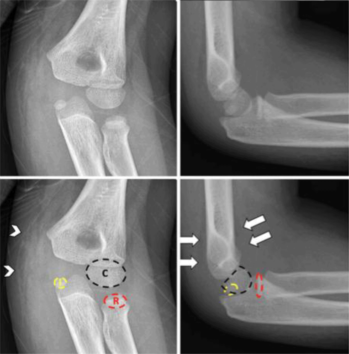 olecranon avulsion fracture