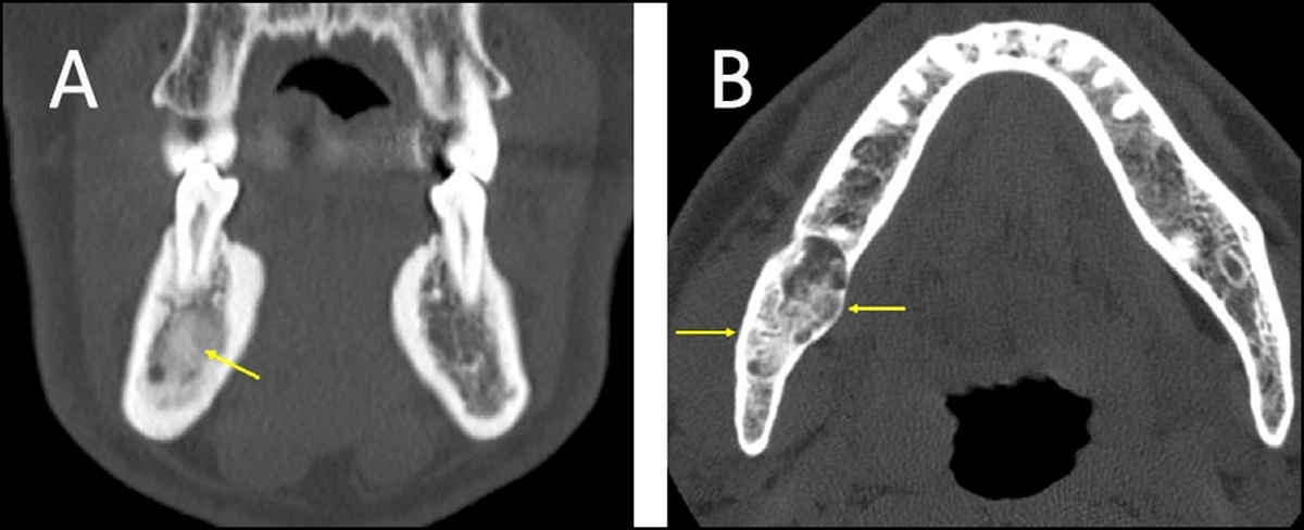 focal sclerosing osteomyelitis