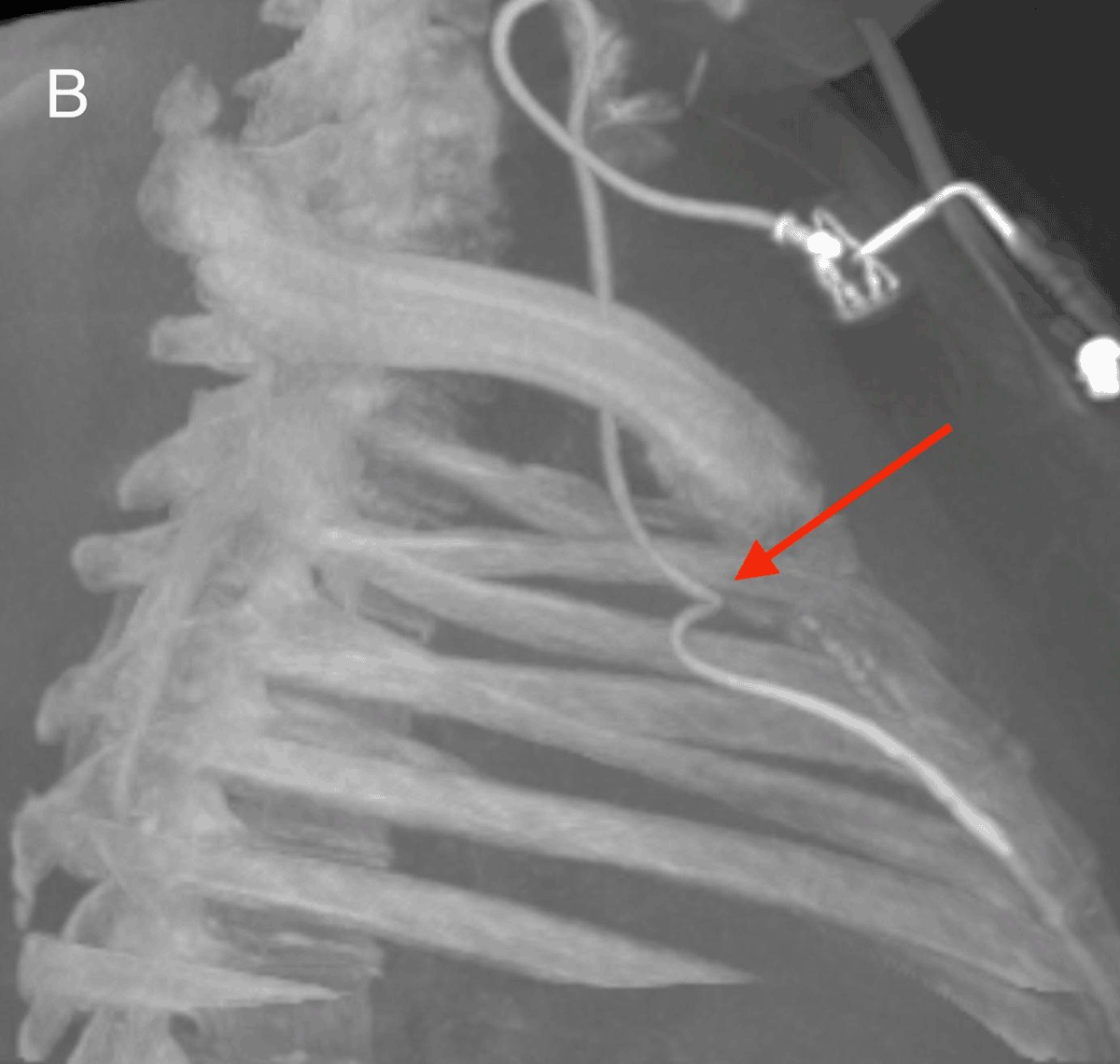 internal thoracic vein