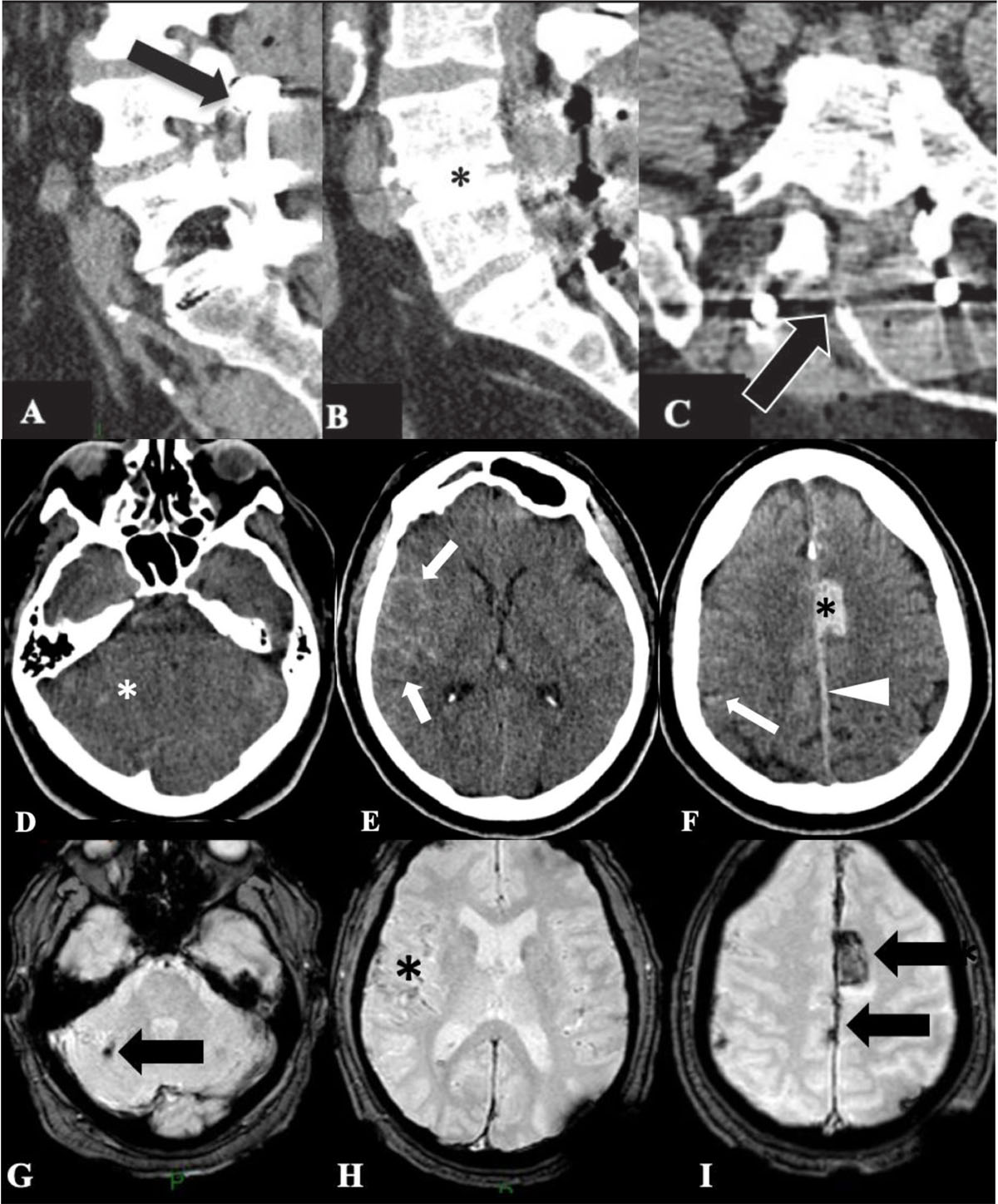 intraparenchymal hemorrhage