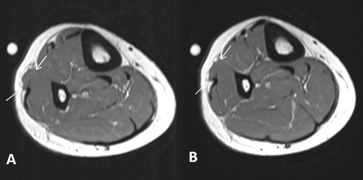 Muscle hernia in a 40-year-old man with a tender palpable mass at