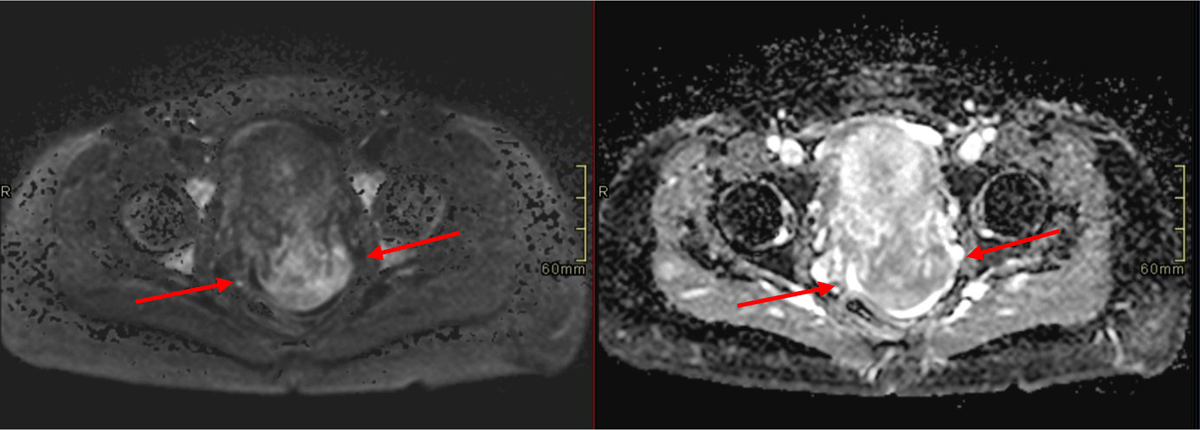 Cervical Adenoma Malignum in Third Trimester Pregnancy - Journal of the  Belgian Society of Radiology