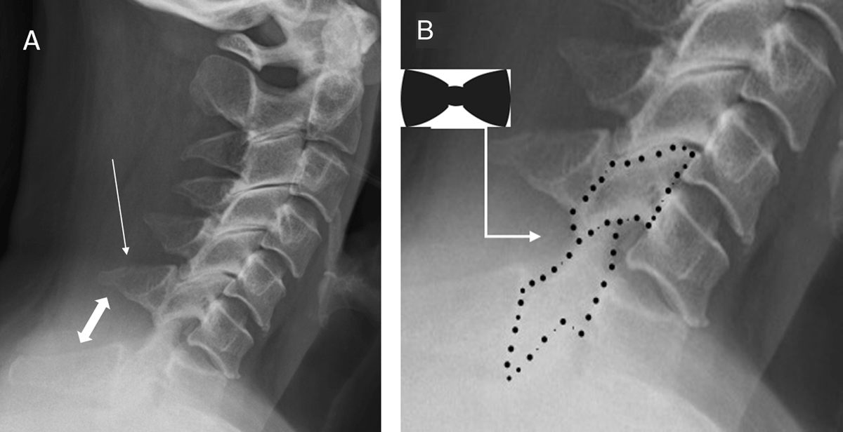 bilateral facet fracture