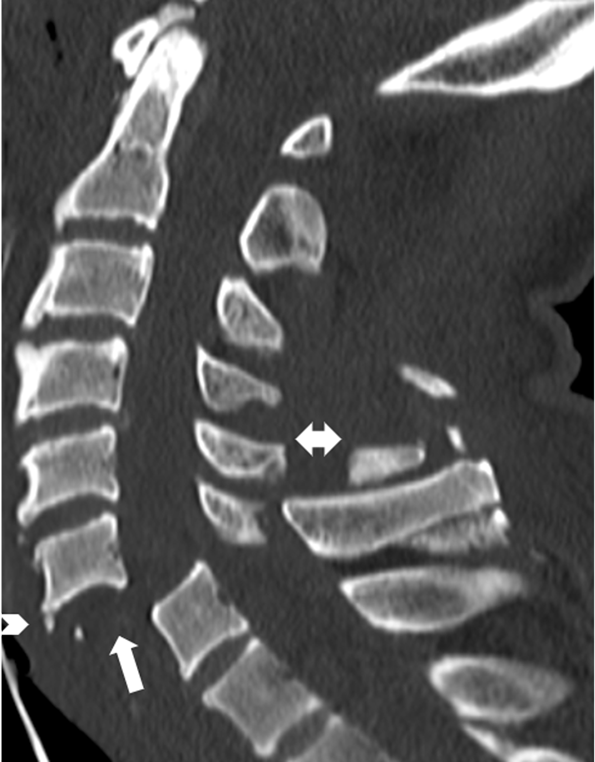 bilateral facet fracture