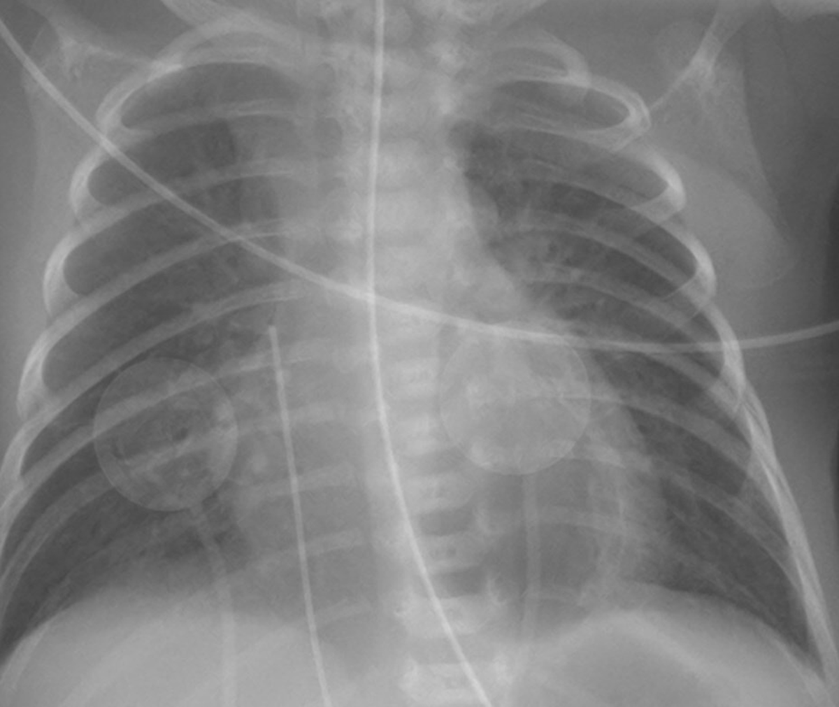 Retrocardiac Lucency in Neonates: Air Trapped in the Pulmonary