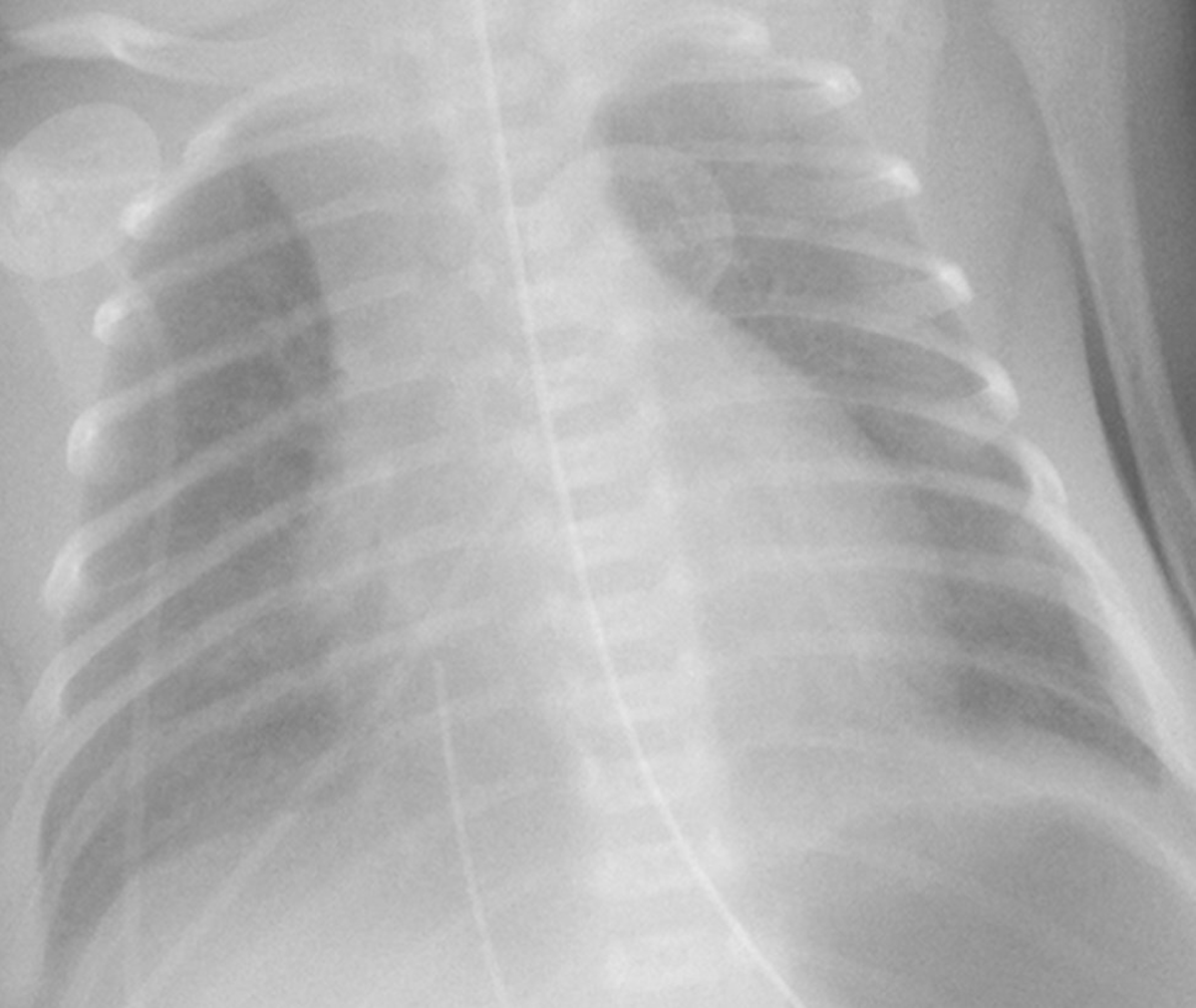 Retrocardiac Lucency in Neonates: Air Trapped in the Pulmonary