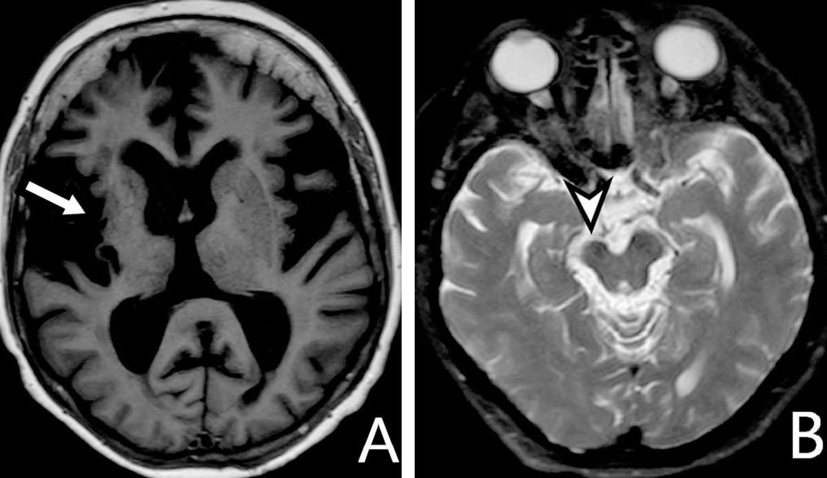 cerebral peduncle mri