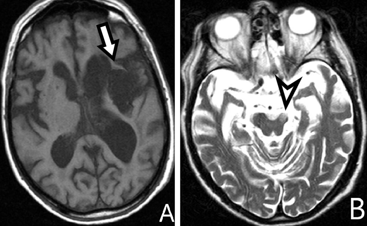 cerebral peduncle mri