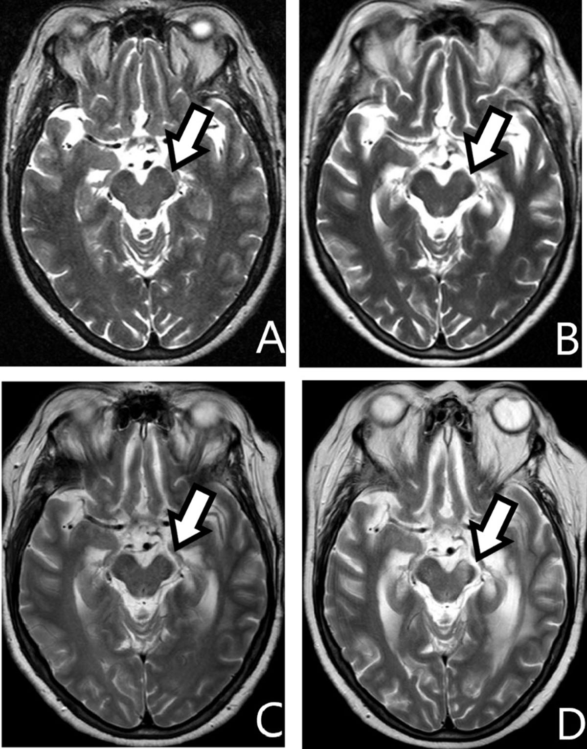 cerebral peduncle mri