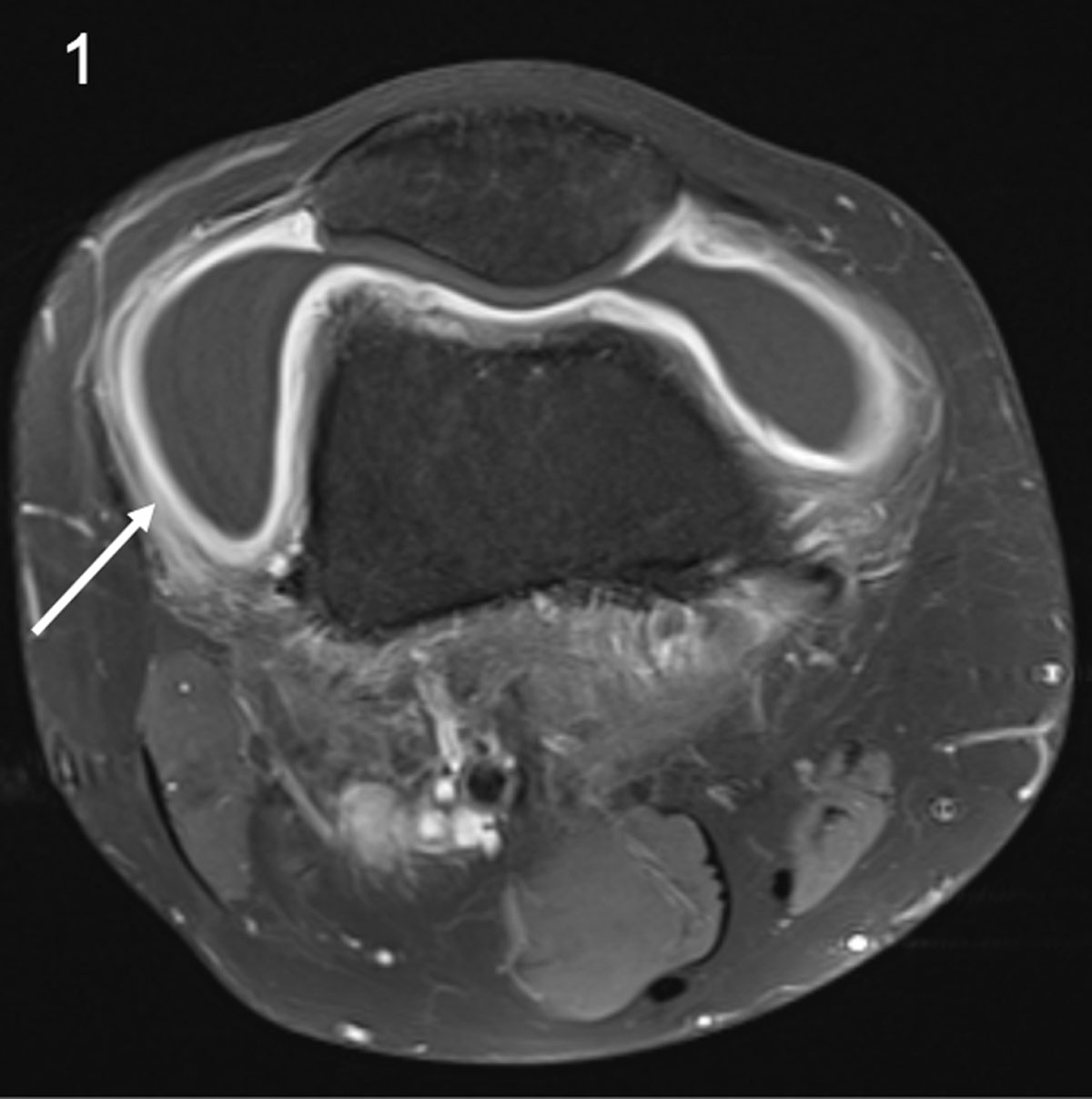 popliteal lymph nodes mri