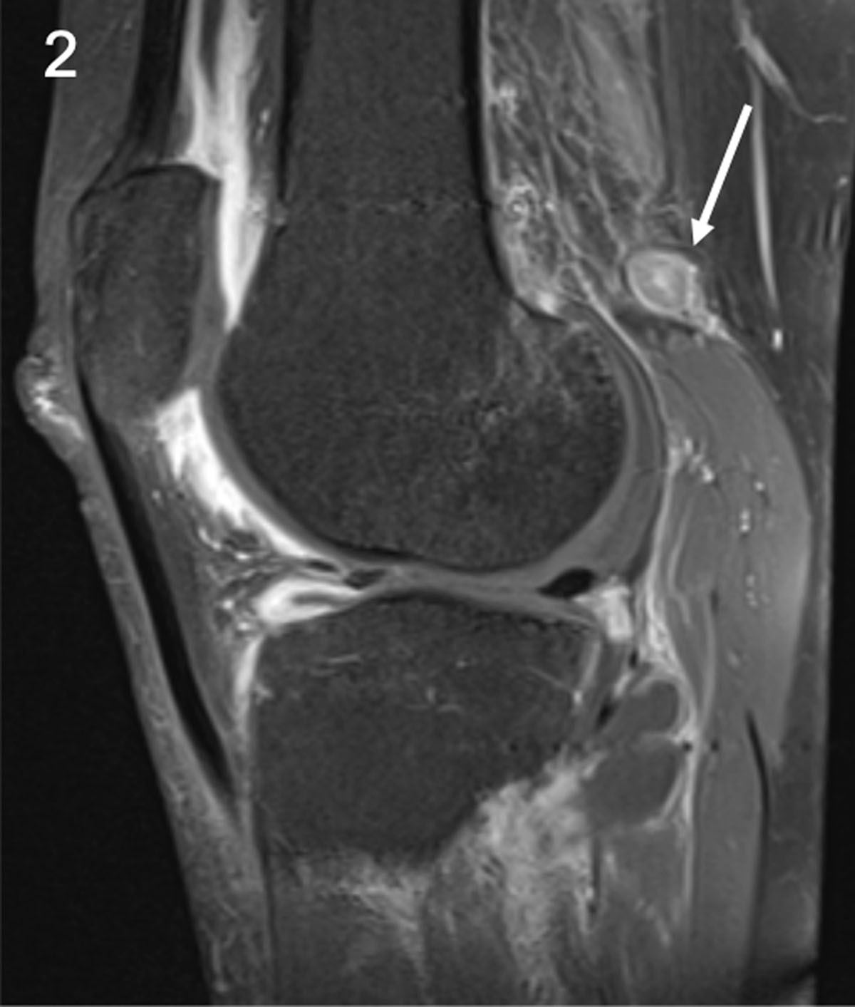 osteoarthritis knee mri