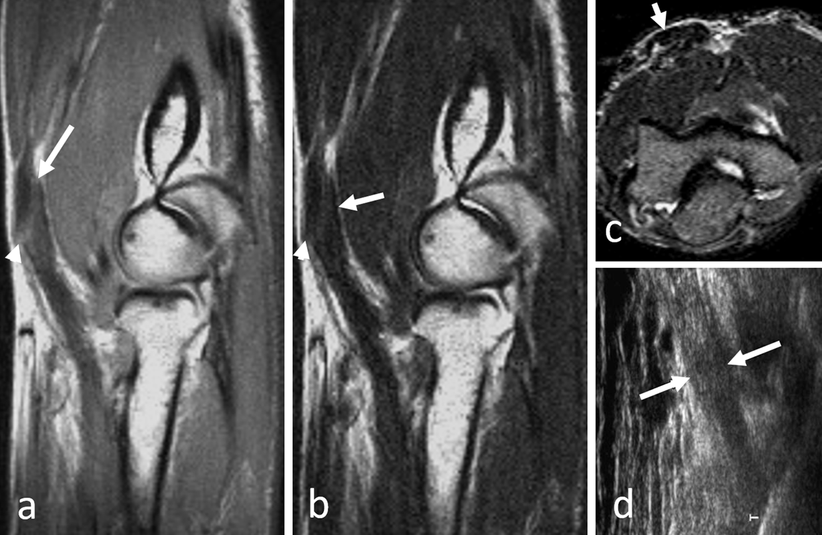 distal biceps tendonitis