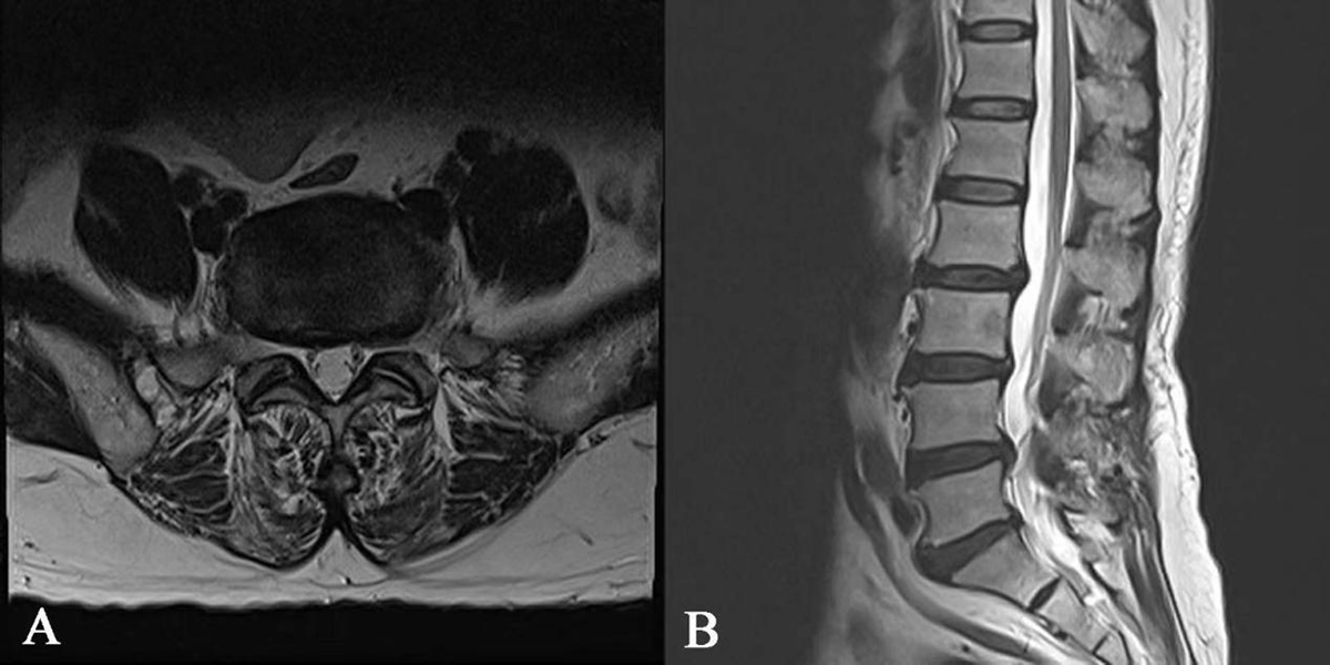 All Herniated Disc Articles