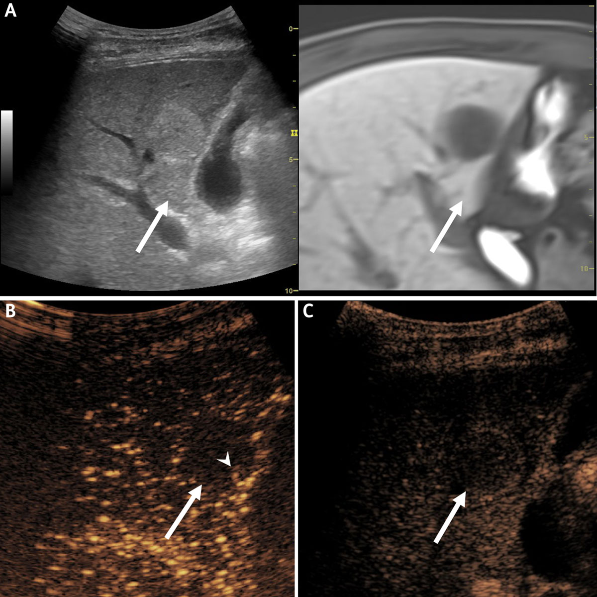 cavernous hemangioma liver ultrasound