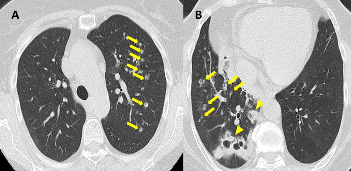 necrotizing pneumonia radiology