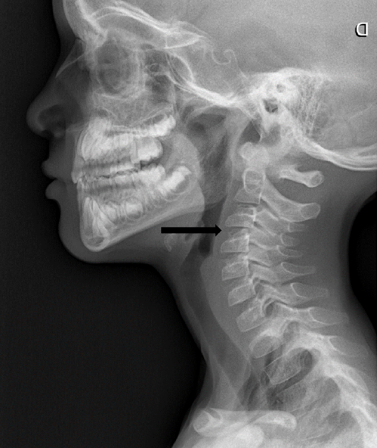 C3, C4, & C5 Vertebrae Spinal Cord Injury