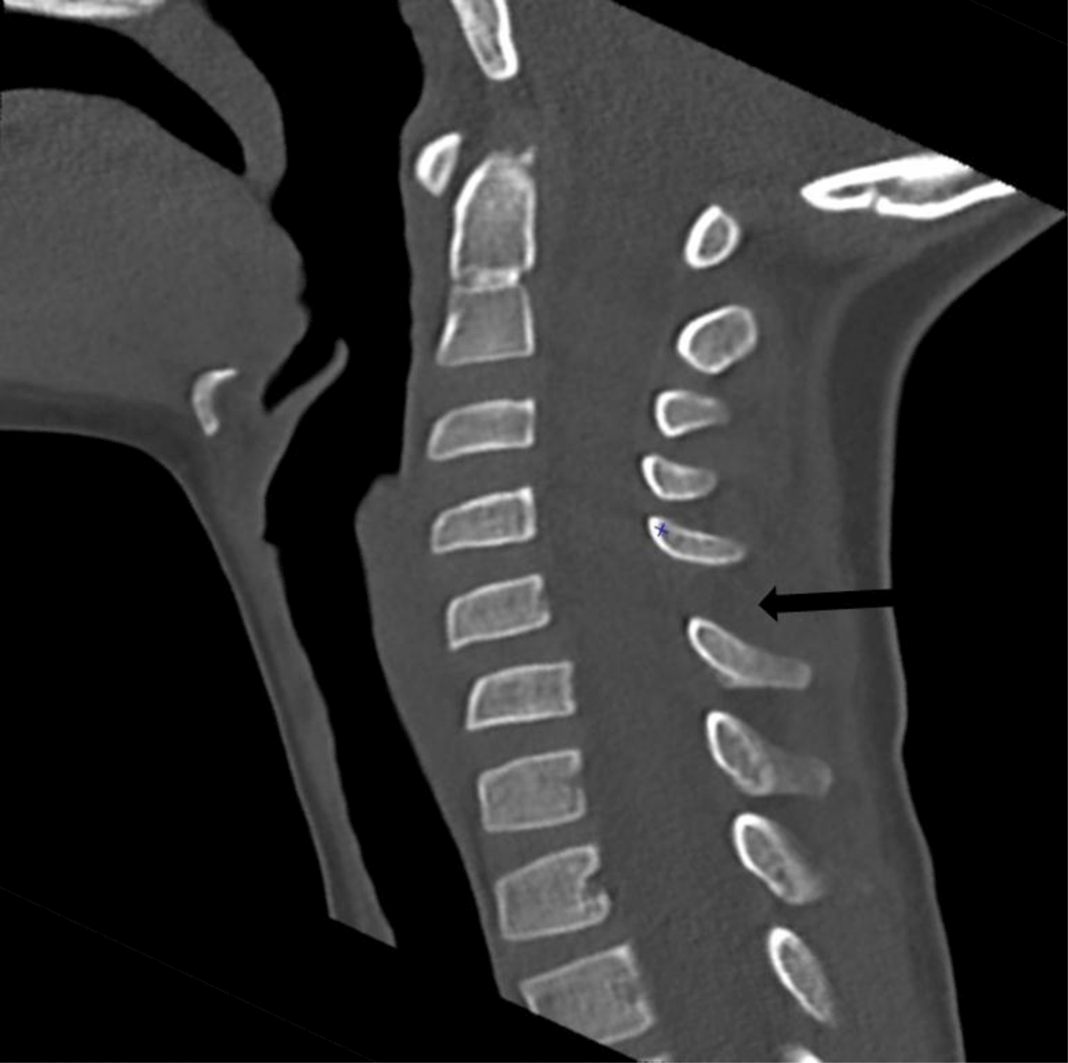 interspinous ligament sprain