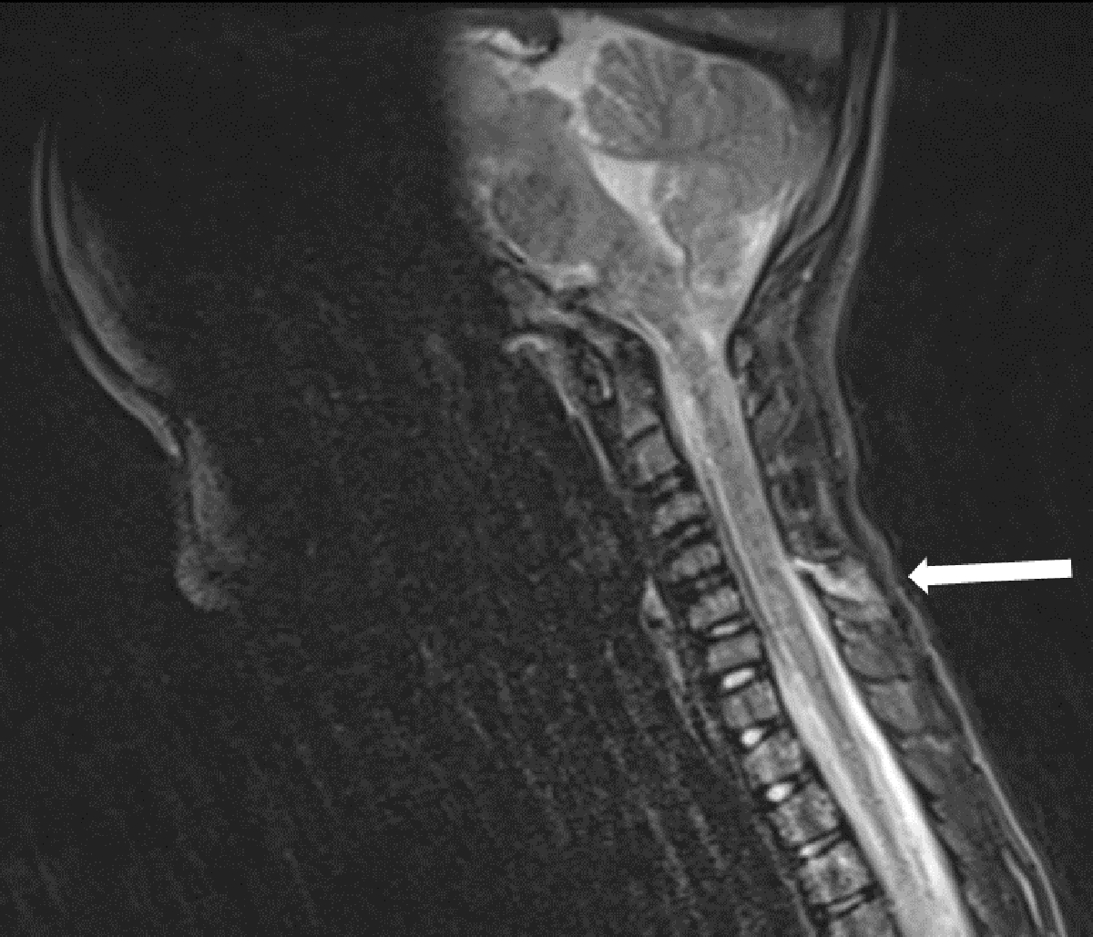 interspinous ligament sprain