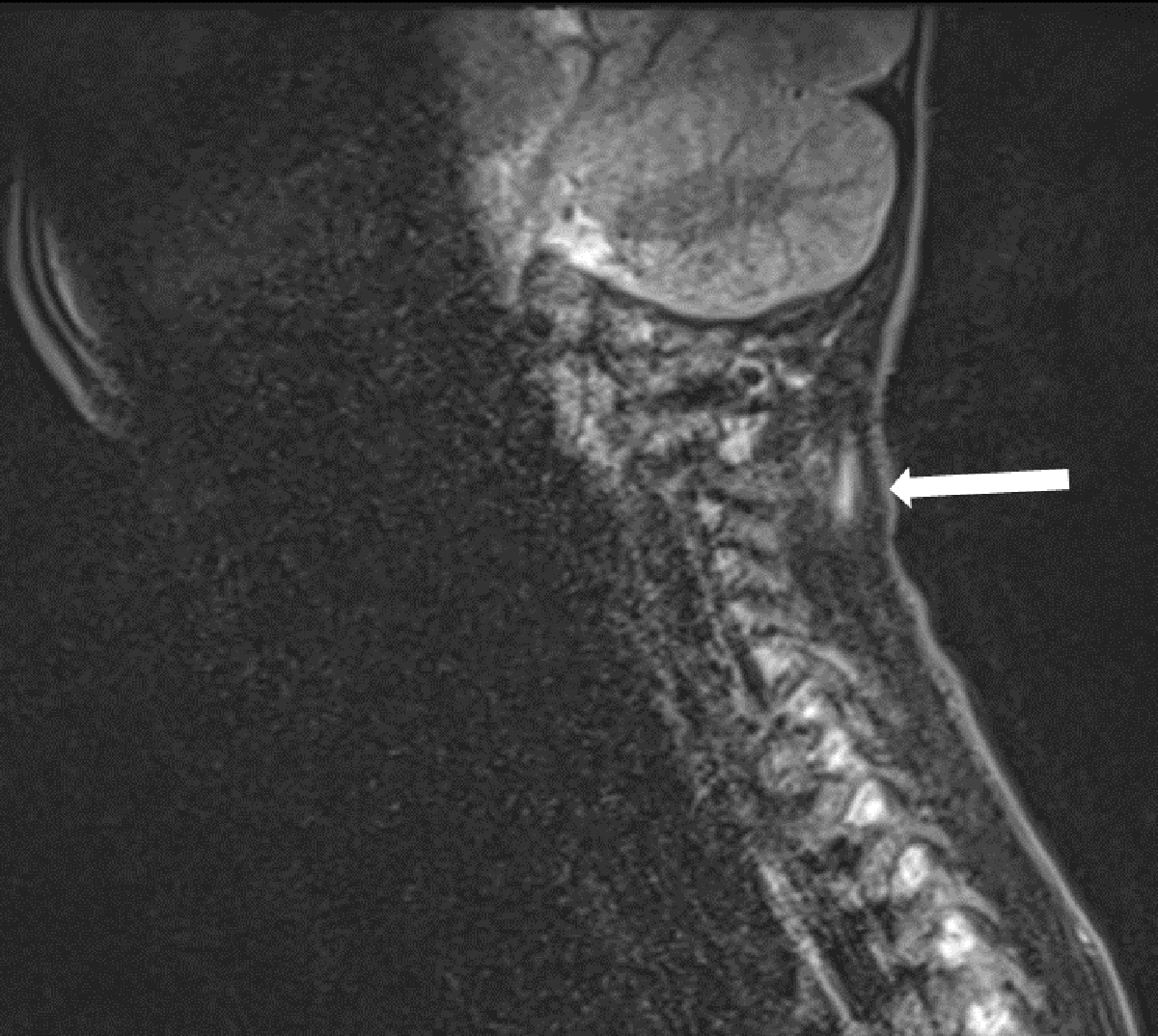 interspinous ligament sprain