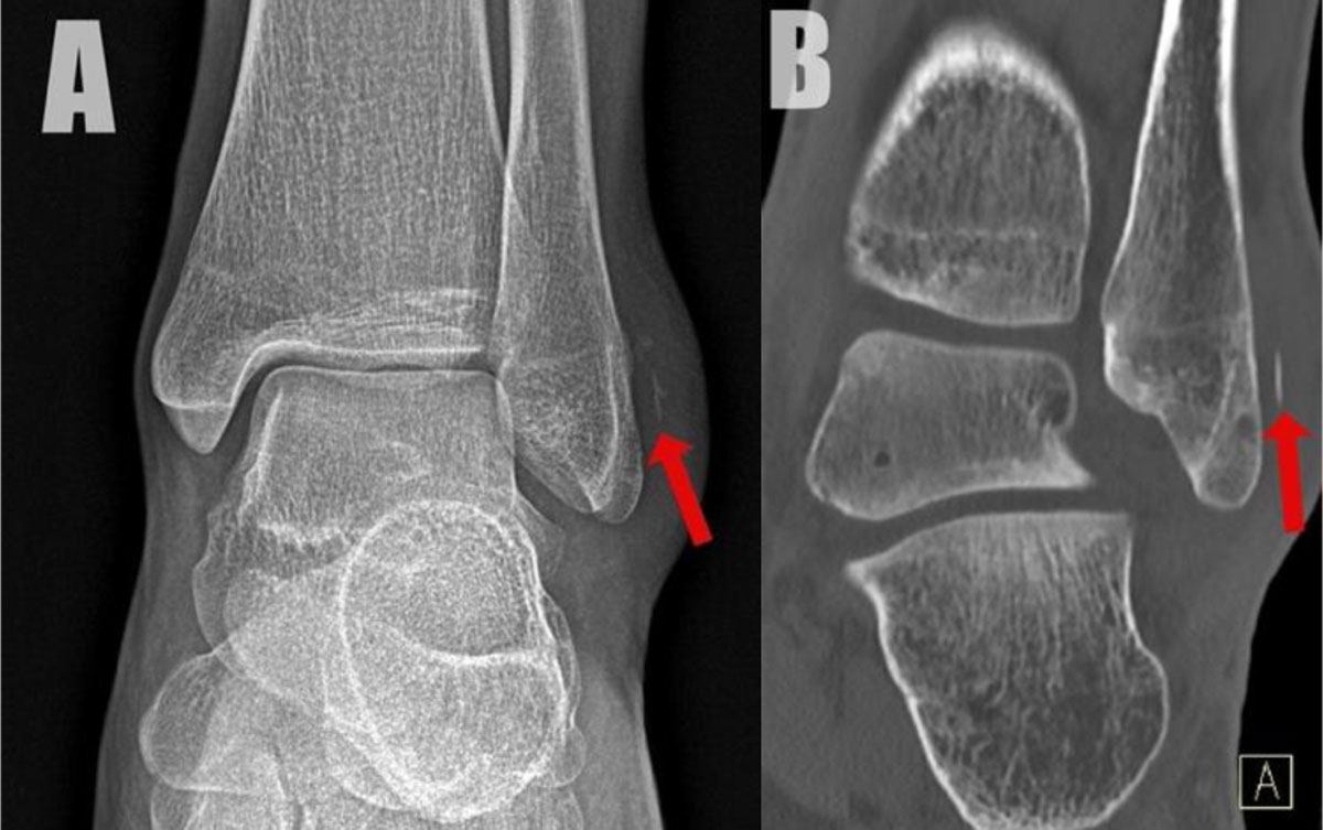 avulsion fracture ankle malleolus