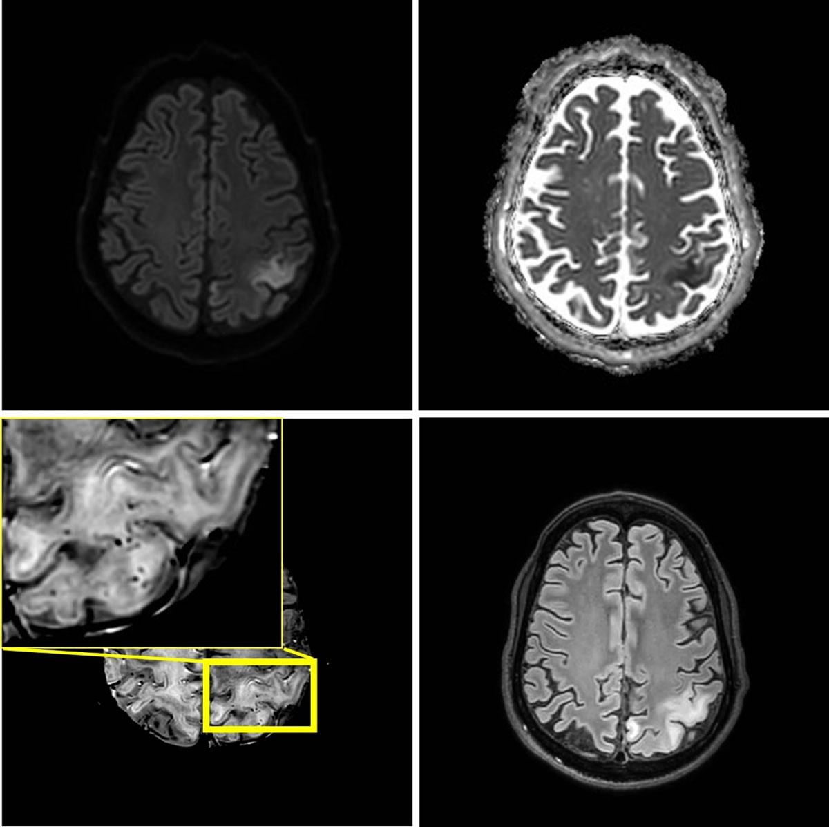 postcentral gyrus mri