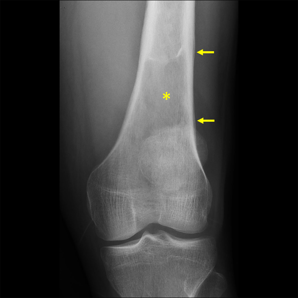 hodgkins lymphoma radiology