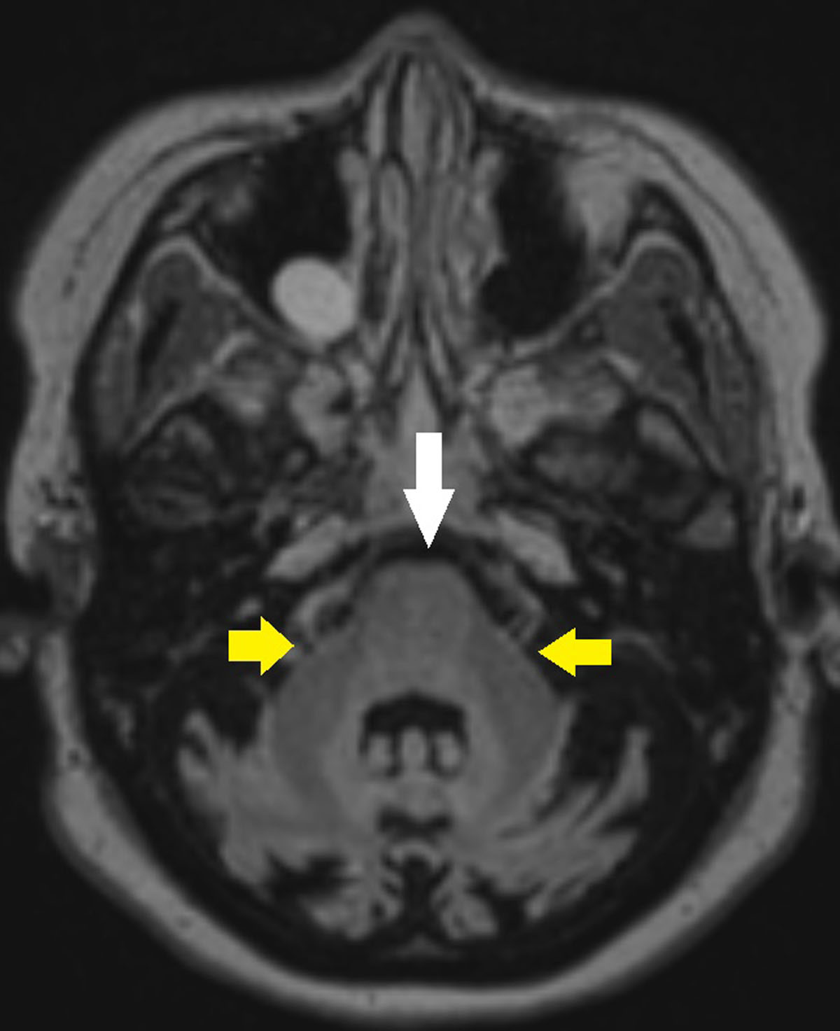 friedreich ataxia mri