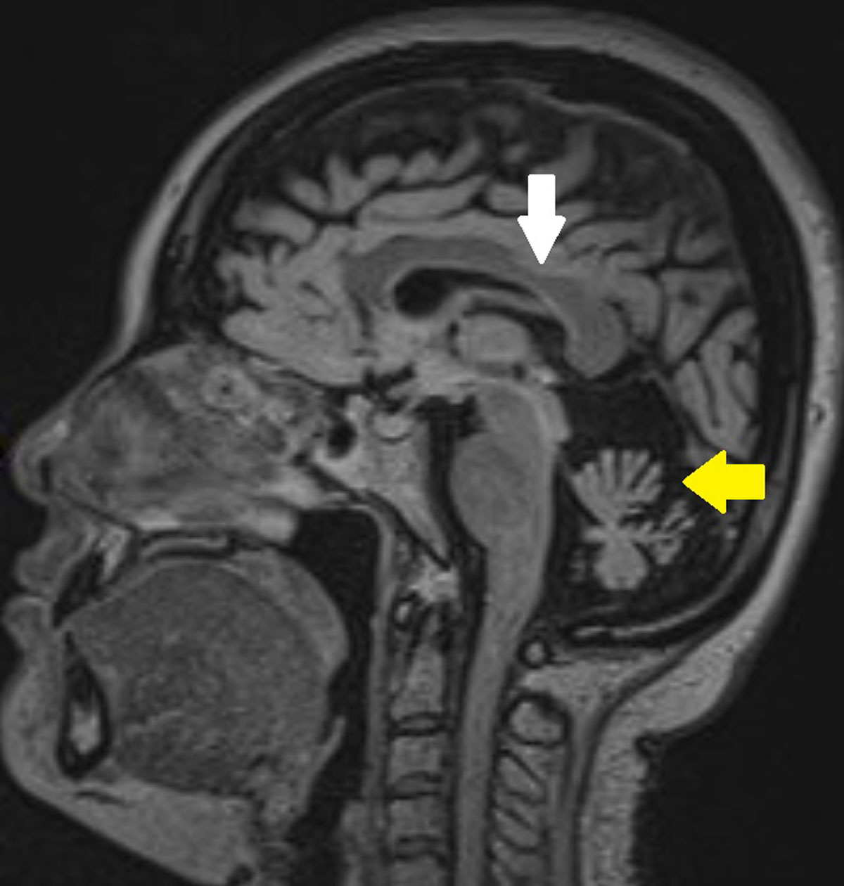 friedreich ataxia mri