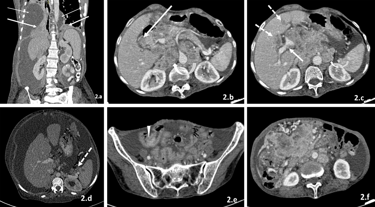 Tuberculous peritonitis mimicking carcinomatosis peritonei: CT findings and  histopathologic correlation - ScienceDirect