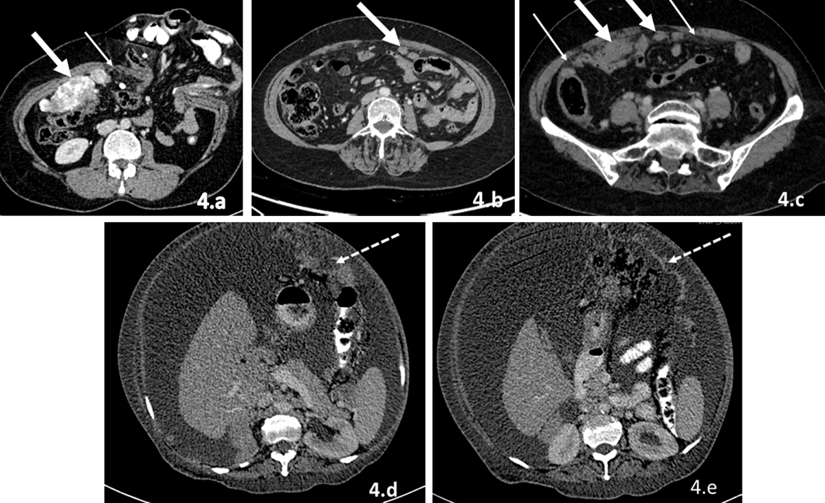 Omental cakes: unusual aetiologies and CT appearances | Insights into  Imaging | Full Text