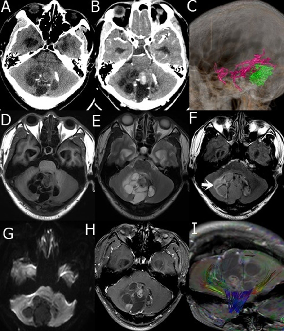 Ring enhancing lesion on CT scan: metastases or a brain abscess? | BMJ Case  Reports