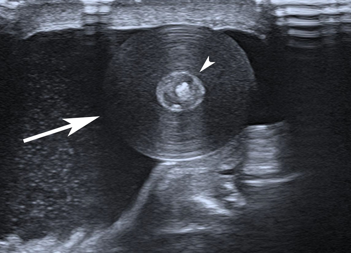 testicular epidermoid cyst