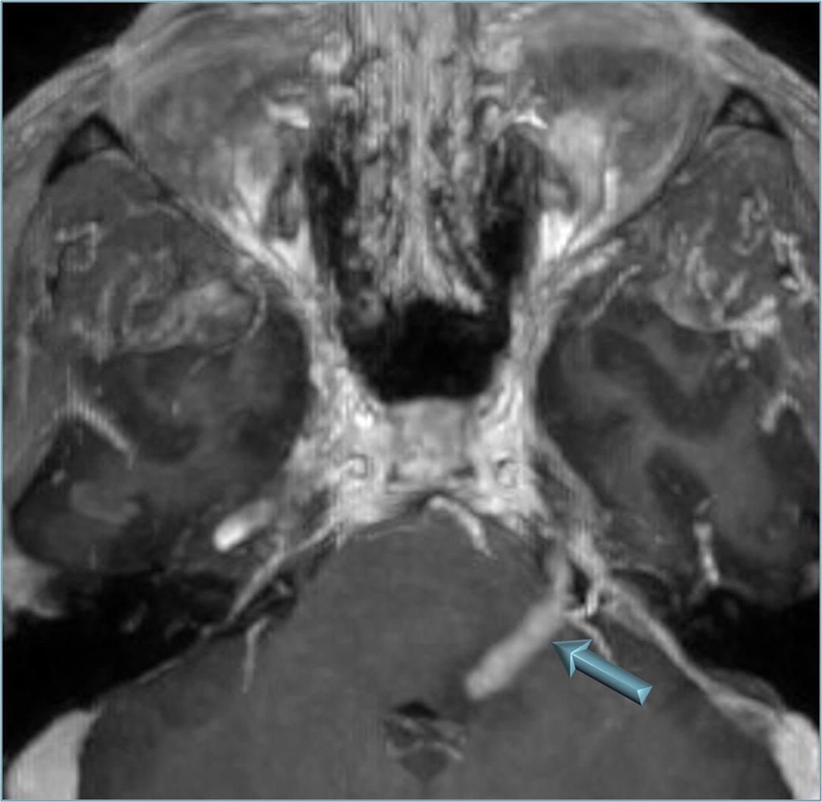 trigeminal nerve mri sagittal