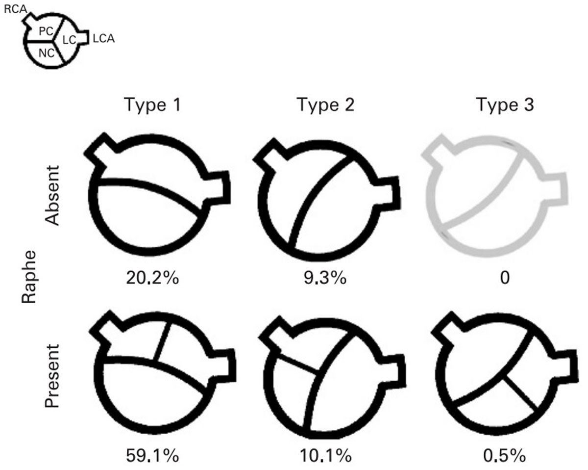 bicuspid aortic valve types